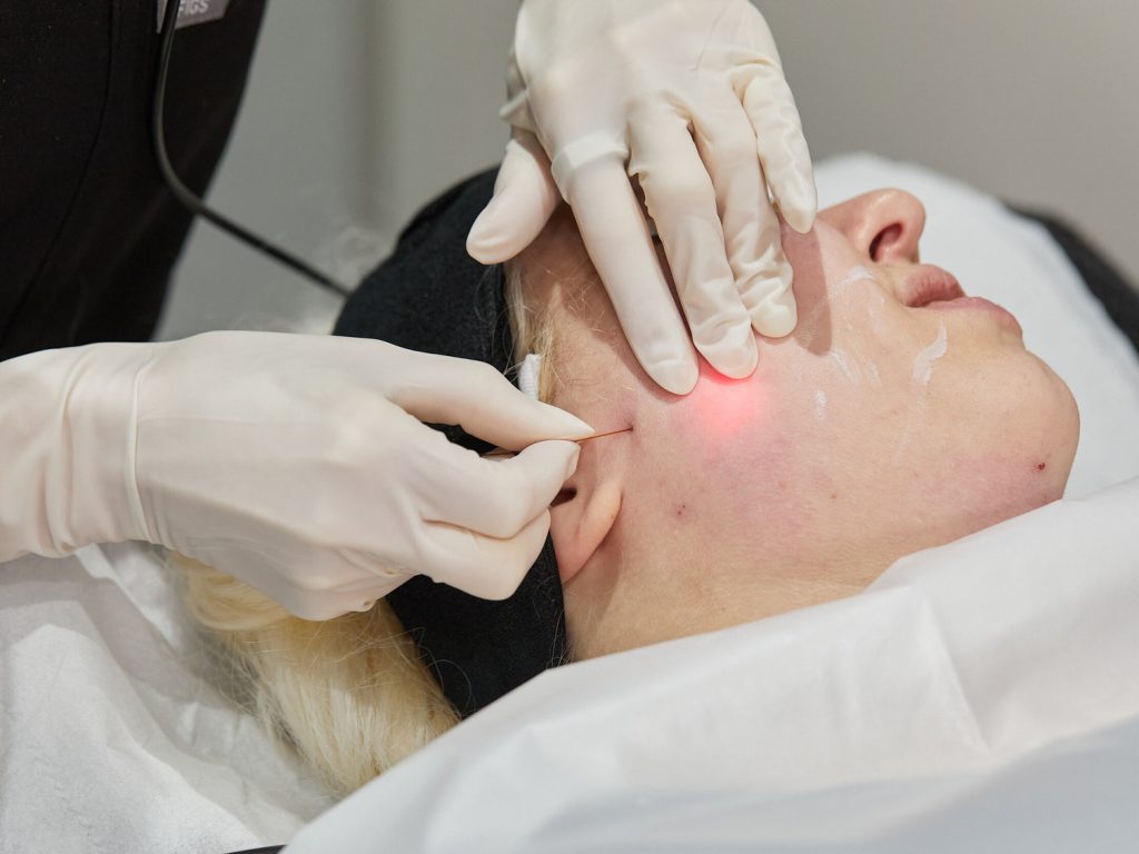 Endolift in Abu Dhabi | Advanced Laser Skin Tightening Treatment